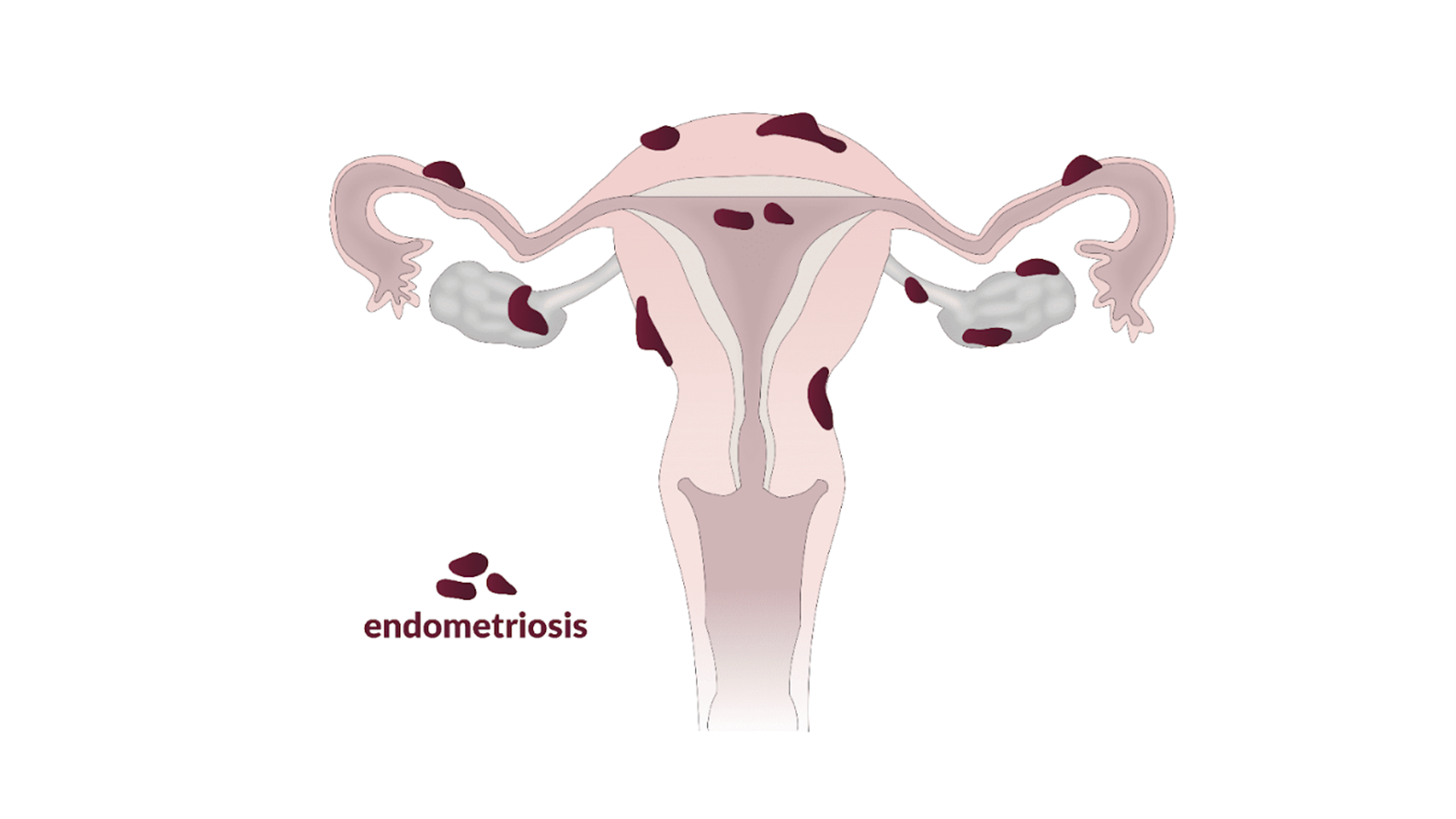 endometriosis